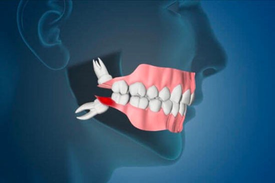 Dente del Giudizio | Dental Factor | Dentista Firenze